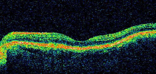 Patterned Pigment Dystrophy of the Fovea 79 YO Woman VA 20/20 Right 20/30 Left
