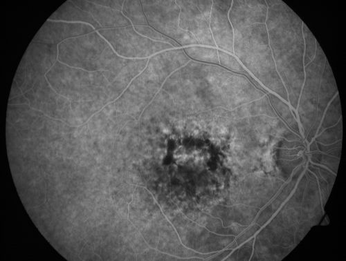 Patterned Pigment Dystrophy of the Fovea 79 YO Woman VA 20/20 Right 20/30 Left
