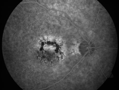 Patterned Pigment Dystrophy of the Fovea 79 YO Woman VA 20/20 Right 20/30 Left
