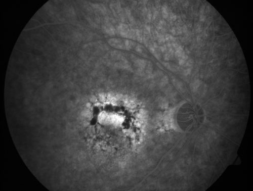 Patterned Pigment Dystrophy of the Fovea 79 YO Woman VA 20/20 Right 20/30 Left
