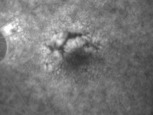Patterned Pigment Dystrophy of the Fovea 79 YO Woman VA 20/20 Right 20/30 Left
