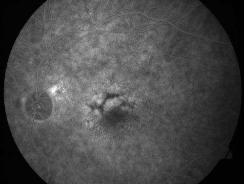 Patterned Pigment Dystrophy of the Fovea 79 YO Woman VA 20/20 Right 20/30 Left
