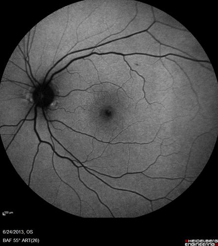 Polypoidal Choroidal Vasculopathy - Right Eye
83 year old female presented in June 2013 with vision loss for 3 months.  She had 2 injections elsewhere with no improvement (avastin).  The first images show a peripapillary CNVM with polyps.  I treated her once with PDT and she stayed dry with good vision for 5 years (2019).  VA on presentation 20/80 OD.  Improved to 20/40
