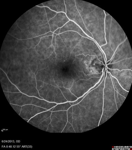 Polypoidal Choroidal Vasculopathy - Right Eye
83 year old female presented in June 2013 with vision loss for 3 months.  She had 2 injections elsewhere with no improvement (avastin).  The first images show a peripapillary CNVM with polyps.  I treated her once with PDT and she stayed dry with good vision for 5 years (2019).  VA on presentation 20/80 OD.  Improved to 20/40
