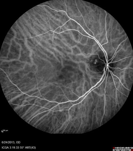 Polypoidal Choroidal Vasculopathy - Right Eye
83 year old female presented in June 2013 with vision loss for 3 months.  She had 2 injections elsewhere with no improvement (avastin).  The first images show a peripapillary CNVM with polyps.  I treated her once with PDT and she stayed dry with good vision for 5 years (2019).  VA on presentation 20/80 OD.  Improved to 20/40
