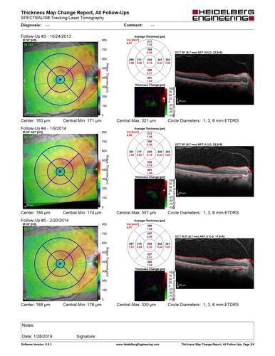 Polypoidal Choroidal Vasculopathy - Right Eye
83 year old female presented in June 2013 with vision loss for 3 months.  She had 2 injections elsewhere with no improvement (avastin).  The first images show a peripapillary CNVM with polyps.  I treated her once with PDT and she stayed dry with good vision for 5 years (2019).  VA on presentation 20/80 OD.  Improved to 20/40
