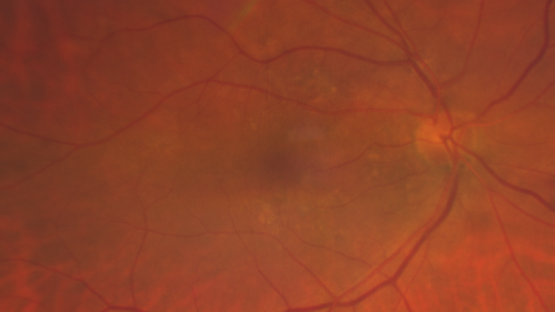 Polypiodal Choroidal Vasculopathy - Temporal Macula - Left eye
82 year old man with asymptomatic PCV in the left eye.  Vision 20/50 OD, 20/32 OS  did well with Lucentis
