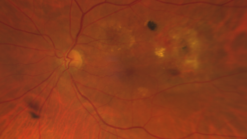 Polypiodal Choroidal Vasculopathy - Temporal Macula - Left eye
82 year old man with asymptomatic PCV in the left eye.  Vision 20/50 OD, 20/32 OS  did well with Lucentis
