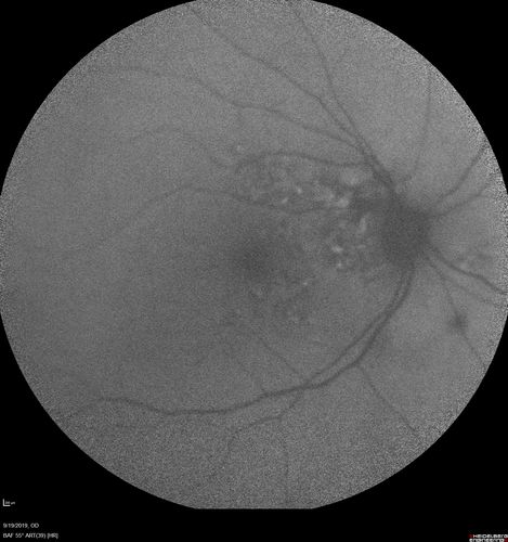 Polypiodal Choroidal Vasculopathy - Temporal Macula - Left eye
82 year old man with asymptomatic PCV in the left eye.  Vision 20/50 OD, 20/32 OS  did well with Lucentis
