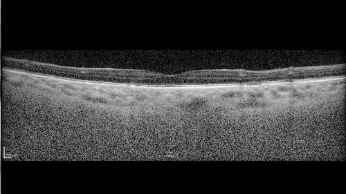 Polypiodal Choroidal Vasculopathy - Temporal Macula - Left eye
82 year old man with asymptomatic PCV in the left eye.  Vision 20/50 OD, 20/32 OS  did well with Lucentis
