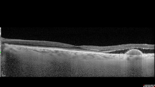 Polypiodal Choroidal Vasculopathy - Temporal Macula - Left eye
82 year old man with asymptomatic PCV in the left eye.  Vision 20/50 OD, 20/32 OS  did well with Lucentis
