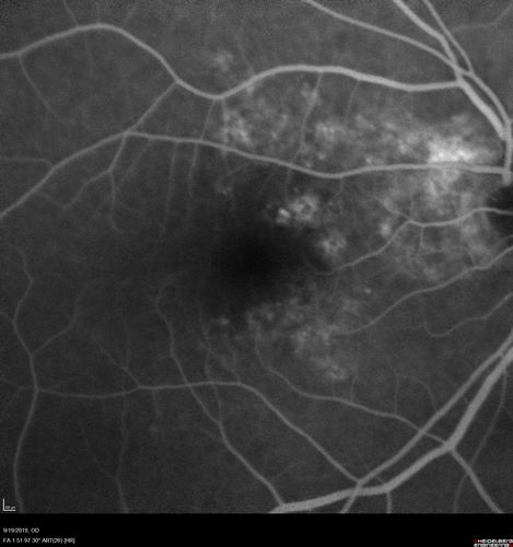 Polypiodal Choroidal Vasculopathy - Temporal Macula - Left eye
82 year old man with asymptomatic PCV in the left eye.  Vision 20/50 OD, 20/32 OS  did well with Lucentis

