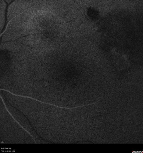 Polypiodal Choroidal Vasculopathy - Temporal Macula - Left eye
82 year old man with asymptomatic PCV in the left eye.  Vision 20/50 OD, 20/32 OS  did well with Lucentis
