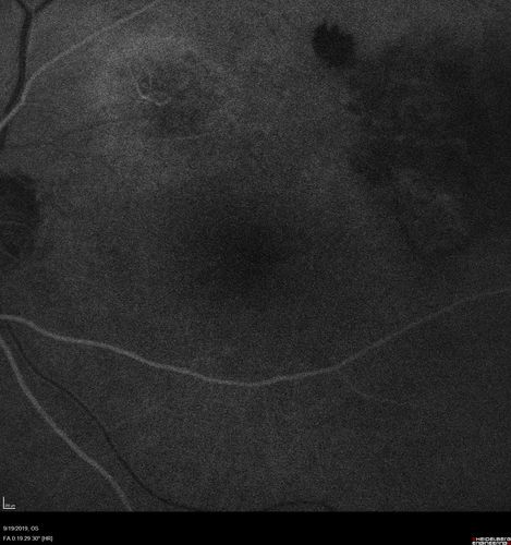 Polypiodal Choroidal Vasculopathy - Temporal Macula - Left eye
82 year old man with asymptomatic PCV in the left eye.  Vision 20/50 OD, 20/32 OS  did well with Lucentis
