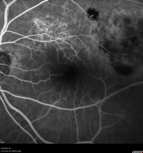Polypiodal Choroidal Vasculopathy - Temporal Macula - Left eye
82 year old man with asymptomatic PCV in the left eye.  Vision 20/50 OD, 20/32 OS  did well with Lucentis
