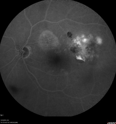 Polypiodal Choroidal Vasculopathy - Temporal Macula - Left eye
82 year old man with asymptomatic PCV in the left eye.  Vision 20/50 OD, 20/32 OS  did well with Lucentis
