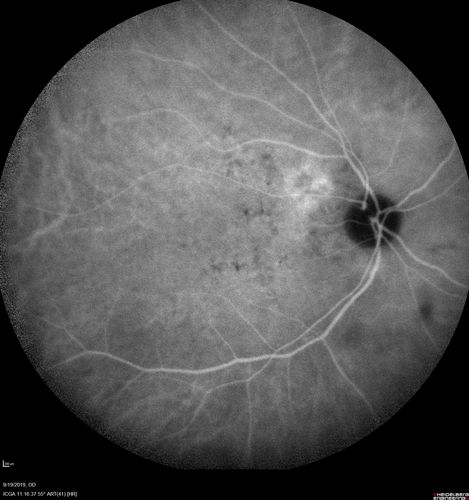 Polypiodal Choroidal Vasculopathy - Temporal Macula - Left eye
82 year old man with asymptomatic PCV in the left eye.  Vision 20/50 OD, 20/32 OS  did well with Lucentis
