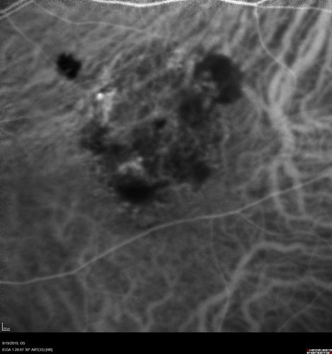 Polypiodal Choroidal Vasculopathy - Temporal Macula - Left eye
82 year old man with asymptomatic PCV in the left eye.  Vision 20/50 OD, 20/32 OS  did well with Lucentis
