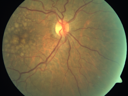 Polypoidal Choroidal Vasculopathy with Pulsating ICG polyp left eye
