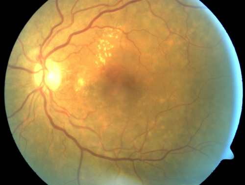 Polypoidal Choroidal Vasculopathy with Pulsating ICG polyp left eye
