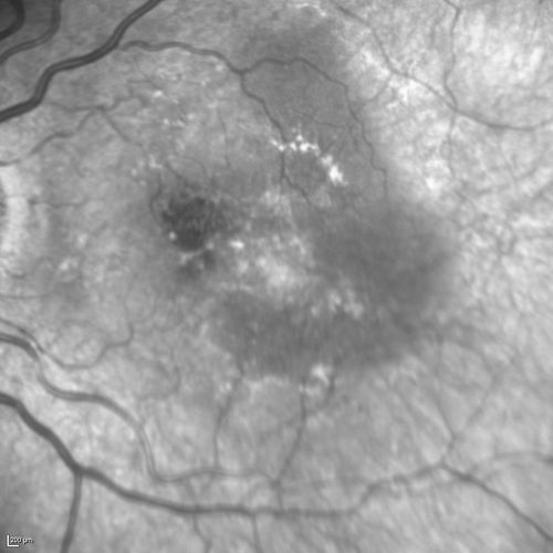 Polypoidal Choroidal Vasculopathy with Pulsating ICG polyp left eye

