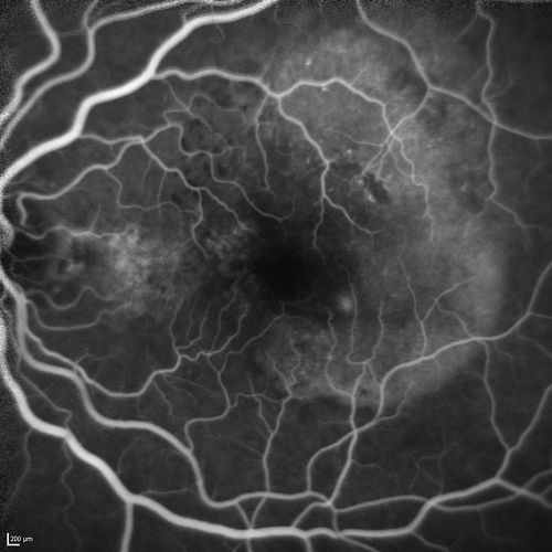 Polypoidal Choroidal Vasculopathy with Pulsating ICG polyp left eye
