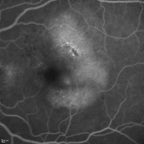 Polypoidal Choroidal Vasculopathy with Pulsating ICG polyp left eye
