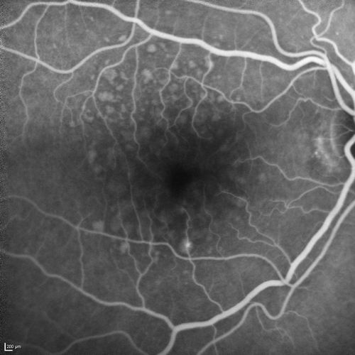 Polypoidal Choroidal Vasculopathy with Pulsating ICG polyp left eye
