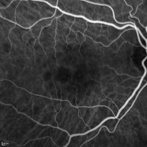 Polypoidal Choroidal Vasculopathy with Pulsating ICG polyp left eye
