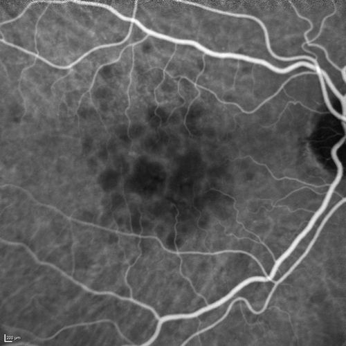 Polypoidal Choroidal Vasculopathy with Pulsating ICG polyp left eye
