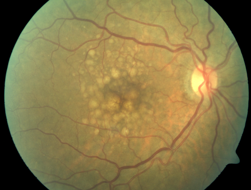Polypoidal Choroidal Vasculopathy with Pulsating ICG polyp left eye
