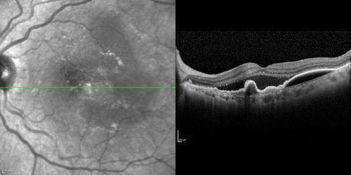 Polypoidal Choroidal Vasculopathy with Pulsating ICG polyp left eye

