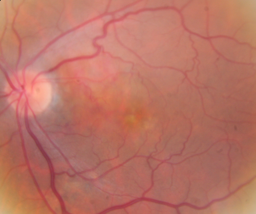 Polypoidal Choroidal Vasculopathy Left Eye
74 year old man with vision loss to 20/100 over a few months.  He improved to 20/20 with Lucentis.  The color and ICG show the polyps.
