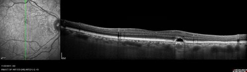 Polypoidal Choroidal Vasculopathy Left Eye
74 year old man with vision loss to 20/100 over a few months.  He improved to 20/20 with Lucentis.  The color and ICG show the polyps.
