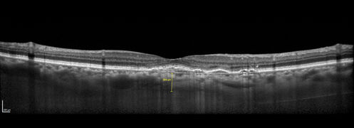 Polypoidal Choroidal Vasculopathy Left Eye
74 year old man with vision loss to 20/100 over a few months.  He improved to 20/20 with Lucentis.  The color and ICG show the polyps.
