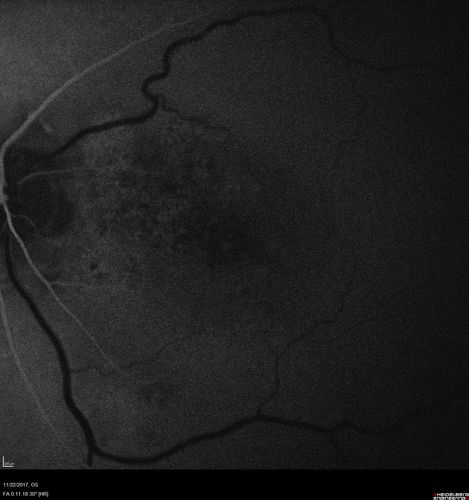 Polypoidal Choroidal Vasculopathy Left Eye
74 year old man with vision loss to 20/100 over a few months.  He improved to 20/20 with Lucentis.  The color and ICG show the polyps.
