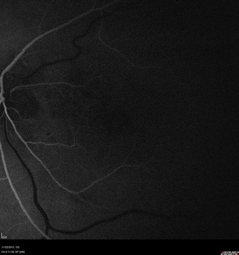 Polypoidal Choroidal Vasculopathy Left Eye
74 year old man with vision loss to 20/100 over a few months.  He improved to 20/20 with Lucentis.  The color and ICG show the polyps.
