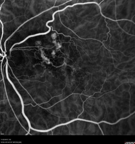 Polypoidal Choroidal Vasculopathy Left Eye
74 year old man with vision loss to 20/100 over a few months.  He improved to 20/20 with Lucentis.  The color and ICG show the polyps.
