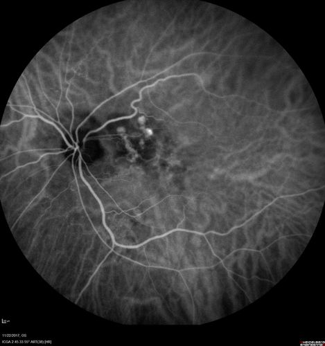 Polypoidal Choroidal Vasculopathy Left Eye
74 year old man with vision loss to 20/100 over a few months.  He improved to 20/20 with Lucentis.  The color and ICG show the polyps.
