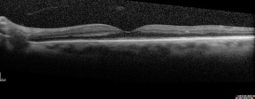 Prethreshold PDR right eye - mild NVD

