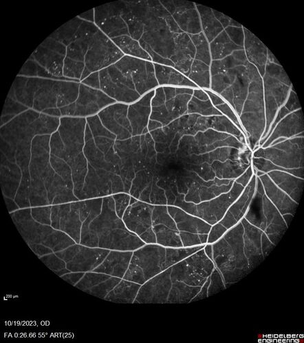 Prethreshold PDR right eye - mild NVD

