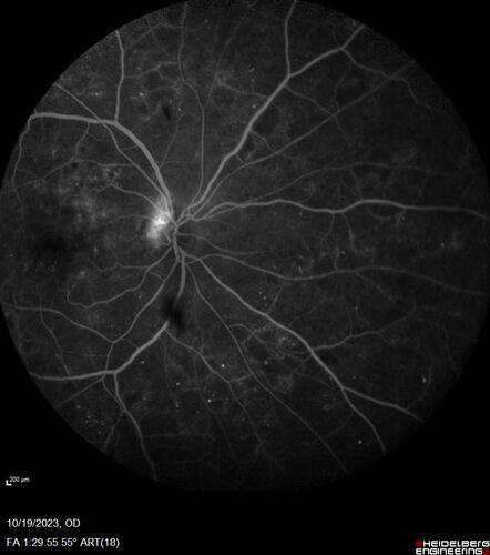 Prethreshold PDR right eye - mild NVD
