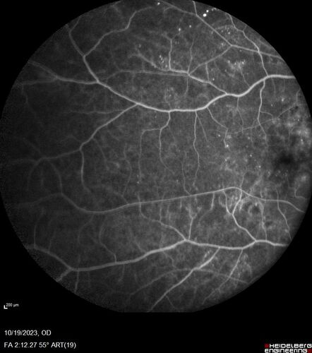 Prethreshold PDR right eye - mild NVD

