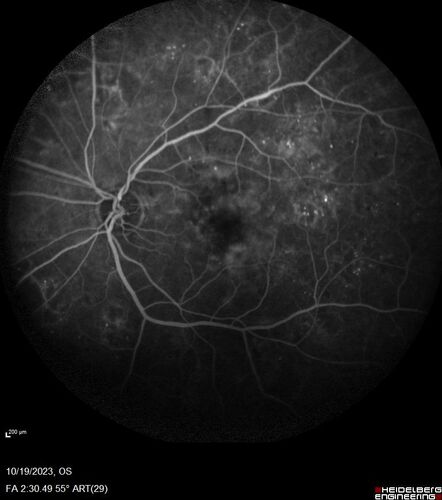 Prethreshold PDR right eye - mild NVD
