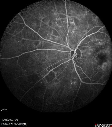 Prethreshold PDR right eye - mild NVD
