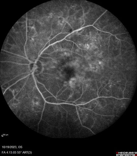Prethreshold PDR right eye - mild NVD

