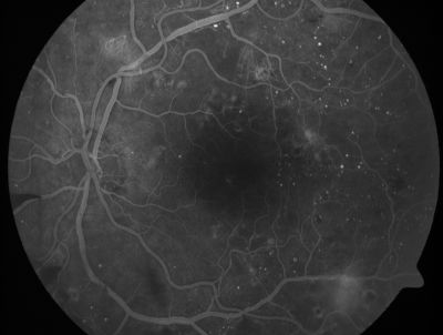 PDR - Mild Vitreous Hemorrhage and Good Vision
58-year-old woman has diabetic retinopathy in both eyes with neovascularization of the optic nerve, worse in the right eye than the left eye.  She has had panretinal laser in both eyes and vitreous hemorrhage in the left eye.  Her vision, since I saw her last in June, is about the same.  

VISUAL ACUITY:  Vision OD is 20/25, OS is 20/20. 
