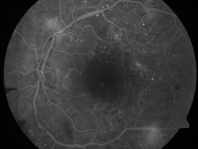 PDR - Mild Vitreous Hemorrhage and Good Vision
58-year-old woman has diabetic retinopathy in both eyes with neovascularization of the optic nerve, worse in the right eye than the left eye.  She has had panretinal laser in both eyes and vitreous hemorrhage in the left eye.  Her vision, since I saw her last in June, is about the same.  

VISUAL ACUITY:  Vision OD is 20/25, OS is 20/20. 
