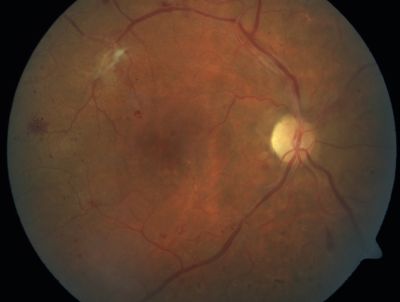 PDR - Mild Vitreous Hemorrhage and Good Vision
58-year-old woman has diabetic retinopathy in both eyes with neovascularization of the optic nerve, worse in the right eye than the left eye.  She has had panretinal laser in both eyes and vitreous hemorrhage in the left eye.  Her vision, since I saw her last in June, is about the same.  

VISUAL ACUITY:  Vision OD is 20/25, OS is 20/20. 
