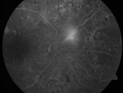 PDR - Mild Vitreous Hemorrhage and Good Vision
58-year-old woman has diabetic retinopathy in both eyes with neovascularization of the optic nerve, worse in the right eye than the left eye.  She has had panretinal laser in both eyes and vitreous hemorrhage in the left eye.  Her vision, since I saw her last in June, is about the same.  

VISUAL ACUITY:  Vision OD is 20/25, OS is 20/20. 
